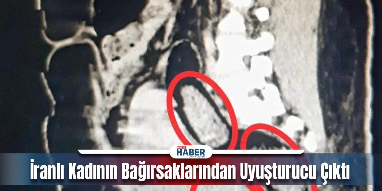 İranlı Kadının Bağırsaklarından Uyuşturucu Çıktı